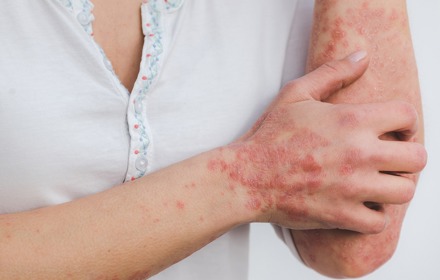 Psoriasis